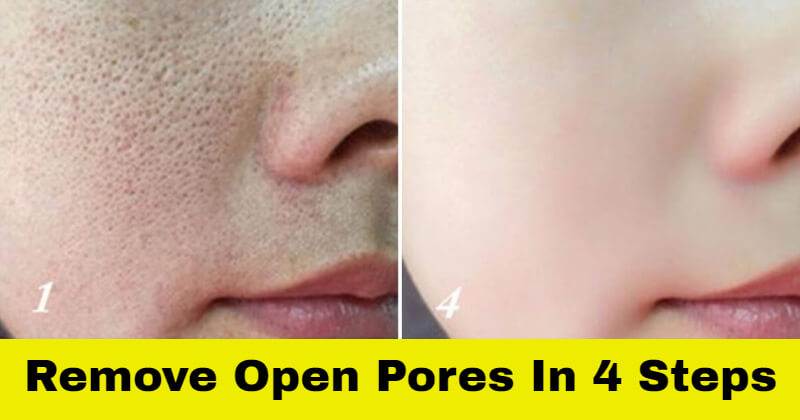 Remove All Open Pores On Your Face Immediately With 4 Natural Steps