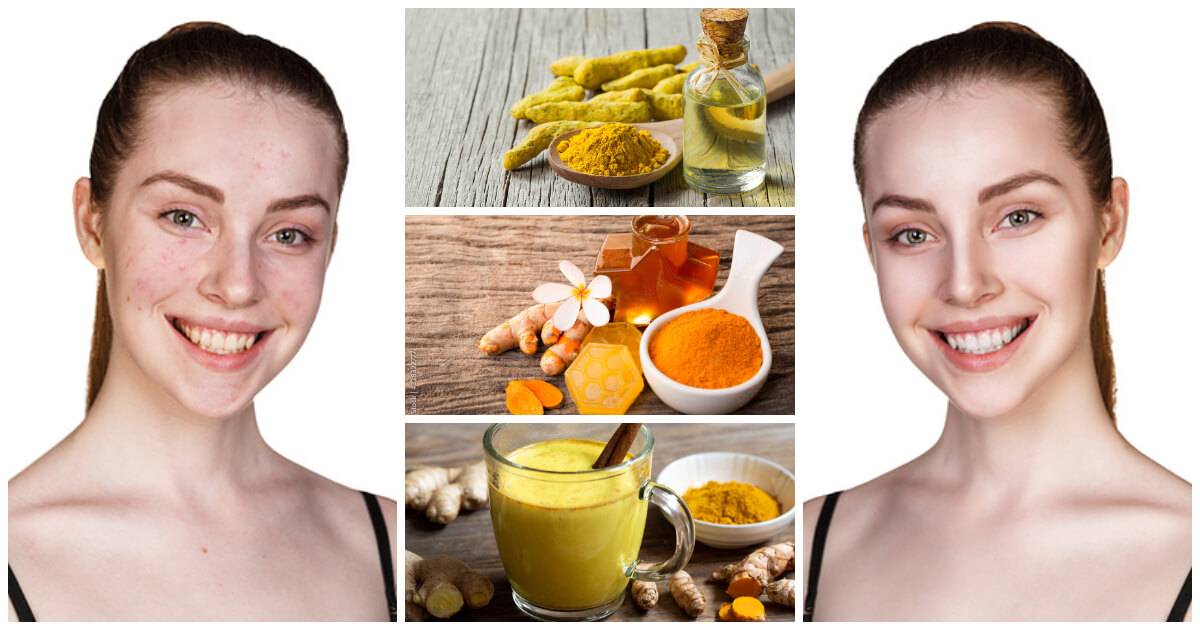 7 Benefits Of Turmeric For Your Skin And How To Use It