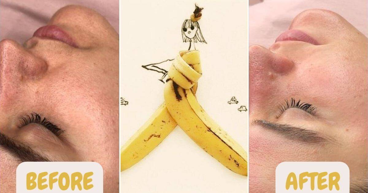 banana-skin-effective-ingredient-to-remove-pimple-dark-spots