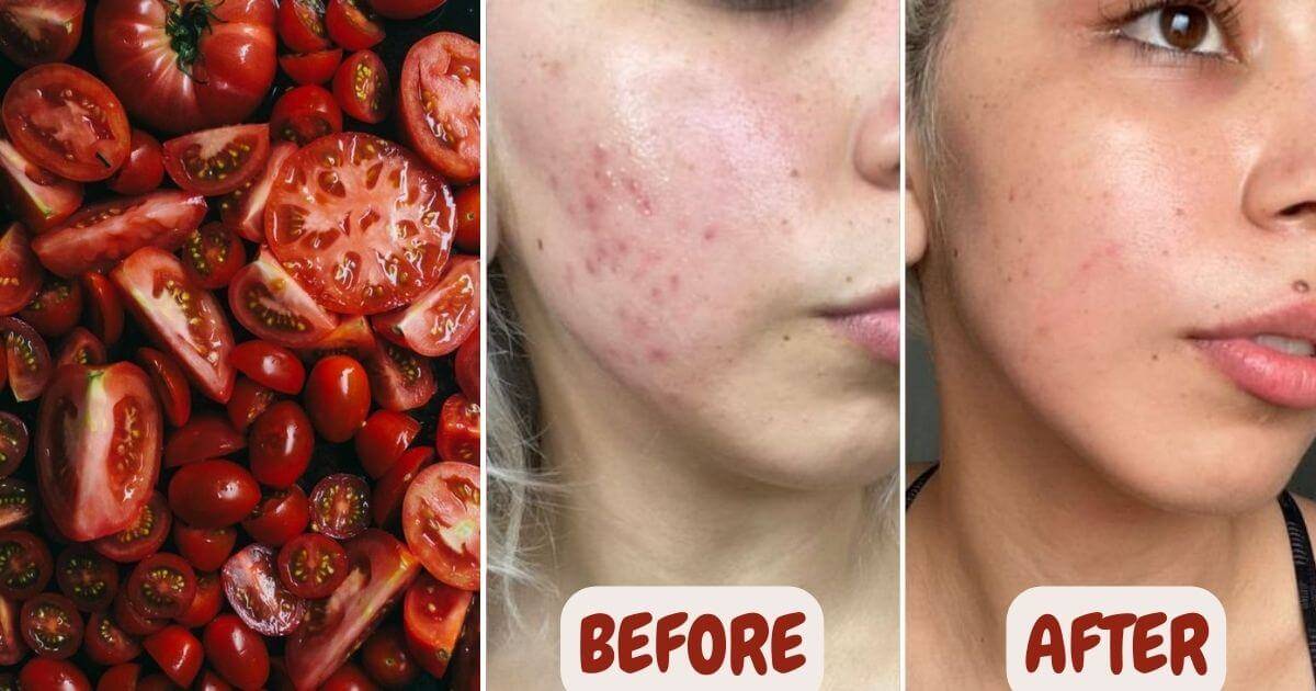 Treat 99 Of Your Skin Problem With DIY Tomato Face Gel