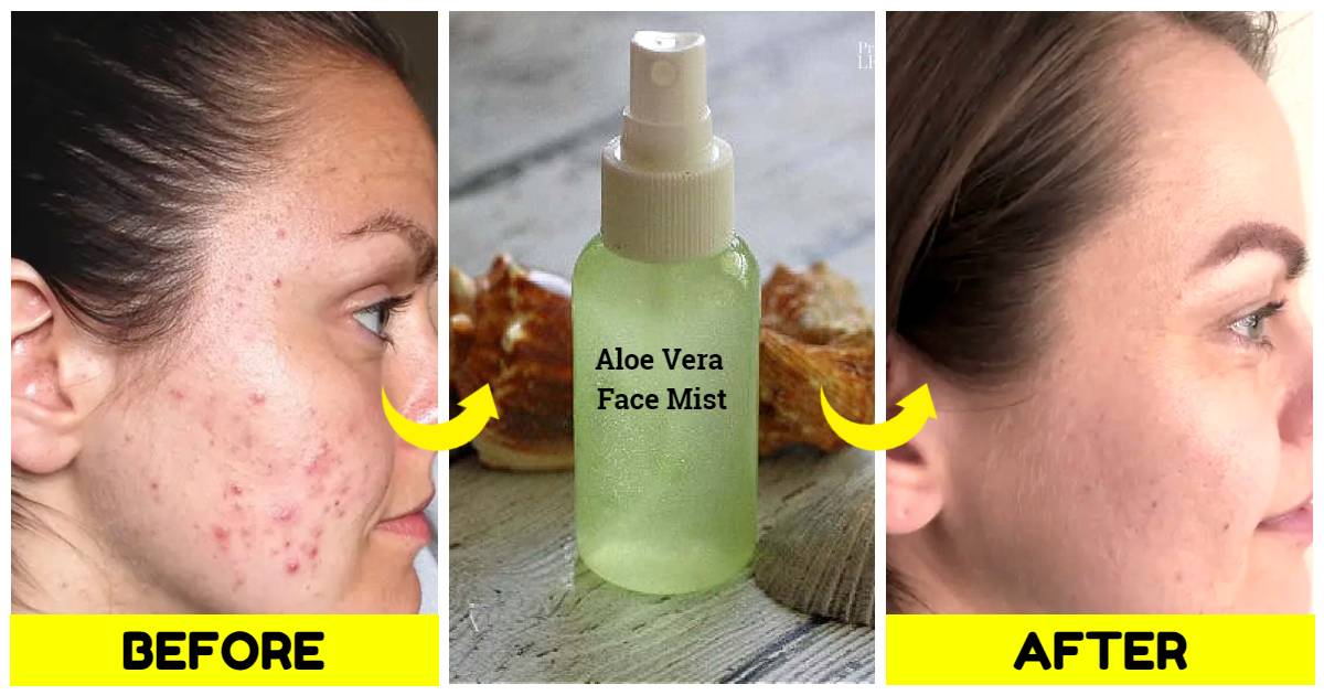 These Aloe Vera Face Masks Will Beat Your Acne Pimples In No Time