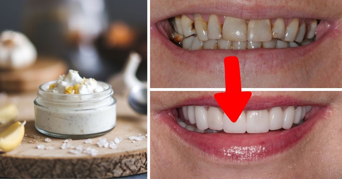 Ditch Chemical Whiteners: Try Garlic and Salt for a Brighter Smile